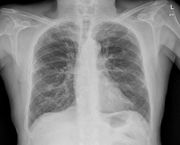 Miniatura Radiografia de pulmons