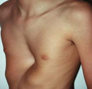 Tòrax d'embut o pectus excavatum: de forma congènita, l'esternum s'enfosa cap a l'interior del tòrax i disminueix el diàmetre toràcic inferior.