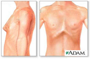 Tòrax en quilla o pectus carinatum: deformitat on l'esternum sobresurt del tòrax.